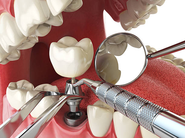 Best Emergency Tooth Extraction in Danvle, IL